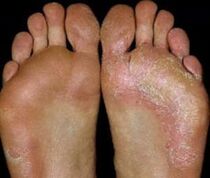 Feet with yeast infection