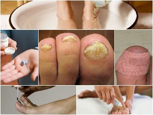 fungus on feet treatment