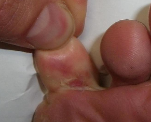 Mycosis of the feet