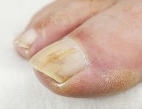 If there is suppuration near the nail, you can not use antifungal drops