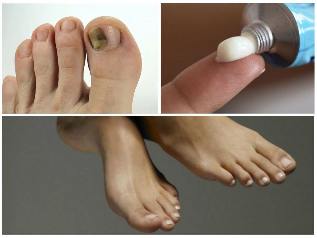 nail fungus on feet treatment