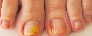 nail fungus on the feet, the symptoms of