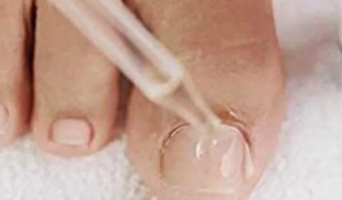 Drops from nail fungus on feet