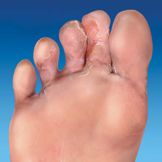 fungus foot skin