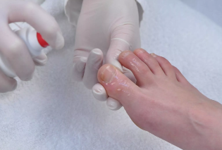 The treatment running with nail fungus