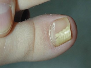 the fungus on the large finger of the foot